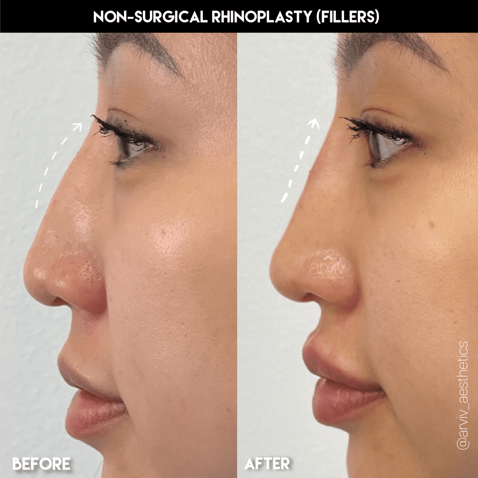 Liquid (Non Surgical) Rhinoplasty in Tampa | Arviv Medical Aesthetics