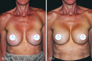 Breast   Before After   Renuva