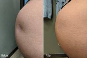 Buttocks2   Before After   Renuva scaled