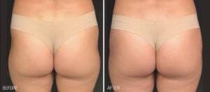 Buttocks   Before After   Renuva