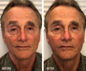 Face_10_-_Before_After_-_Renuva