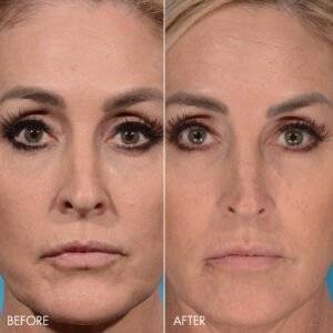 Face_3_-_Before_After_-_Renuva