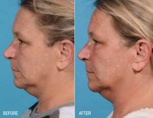 Face 6   Before After   Renuva scaled