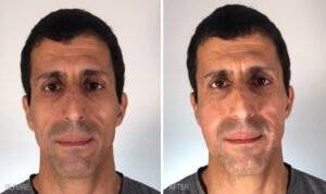 Face 9   Before After   Renuva
