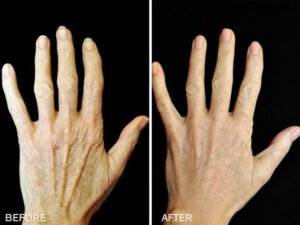 Hands_-_Before_After_-_Renuva