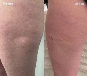 Legs   Before After   Renuva