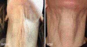 Neck_Before_After_Renuva