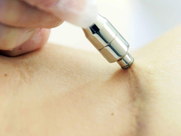 Laser Scar Removal: Cost, Procedures, and What to Expect