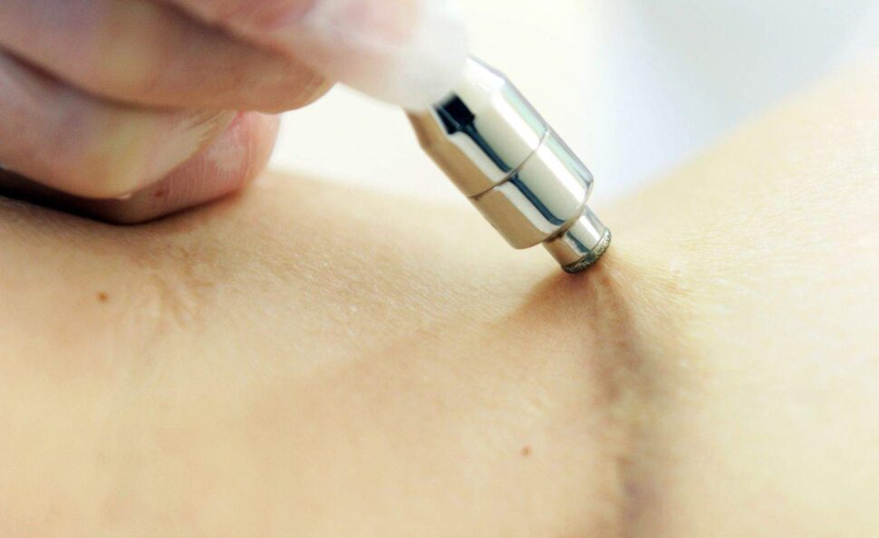Laser Scar Removal