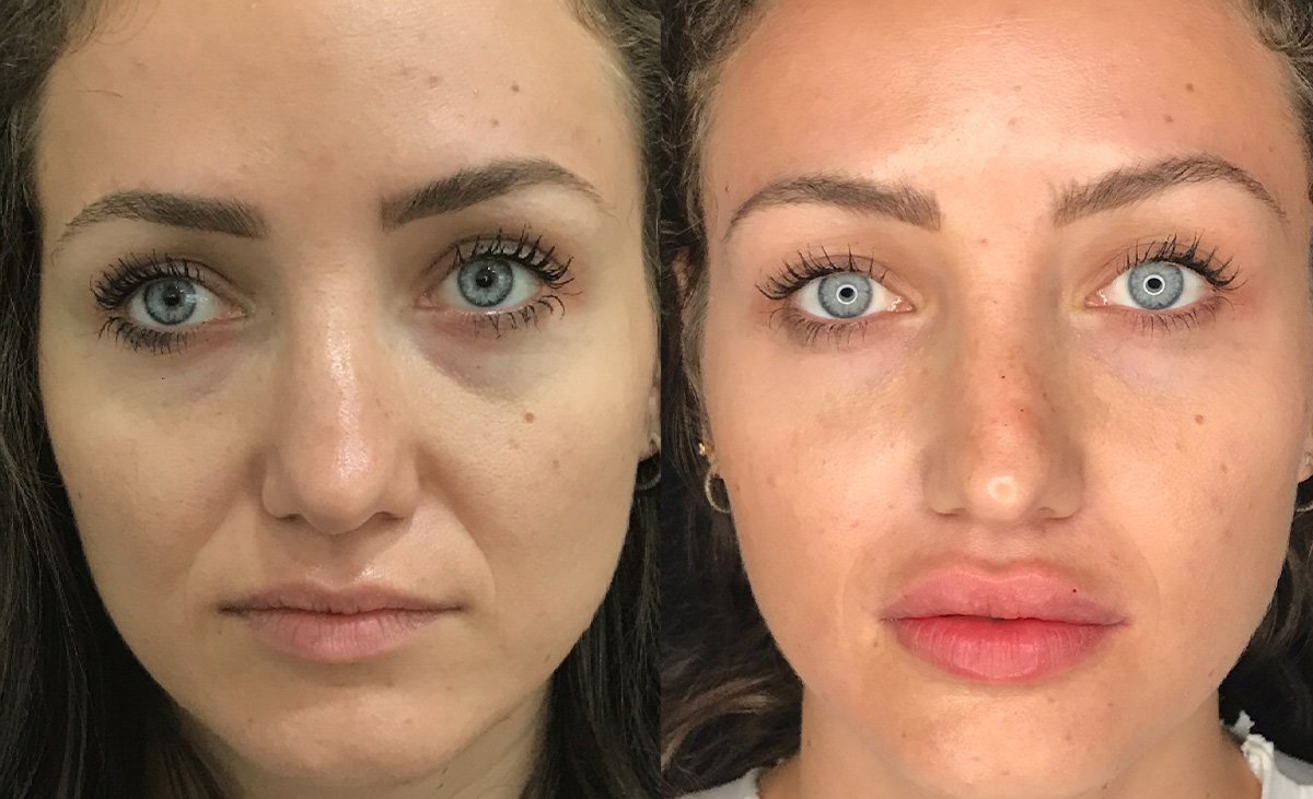 Before and after Liquid Facelift