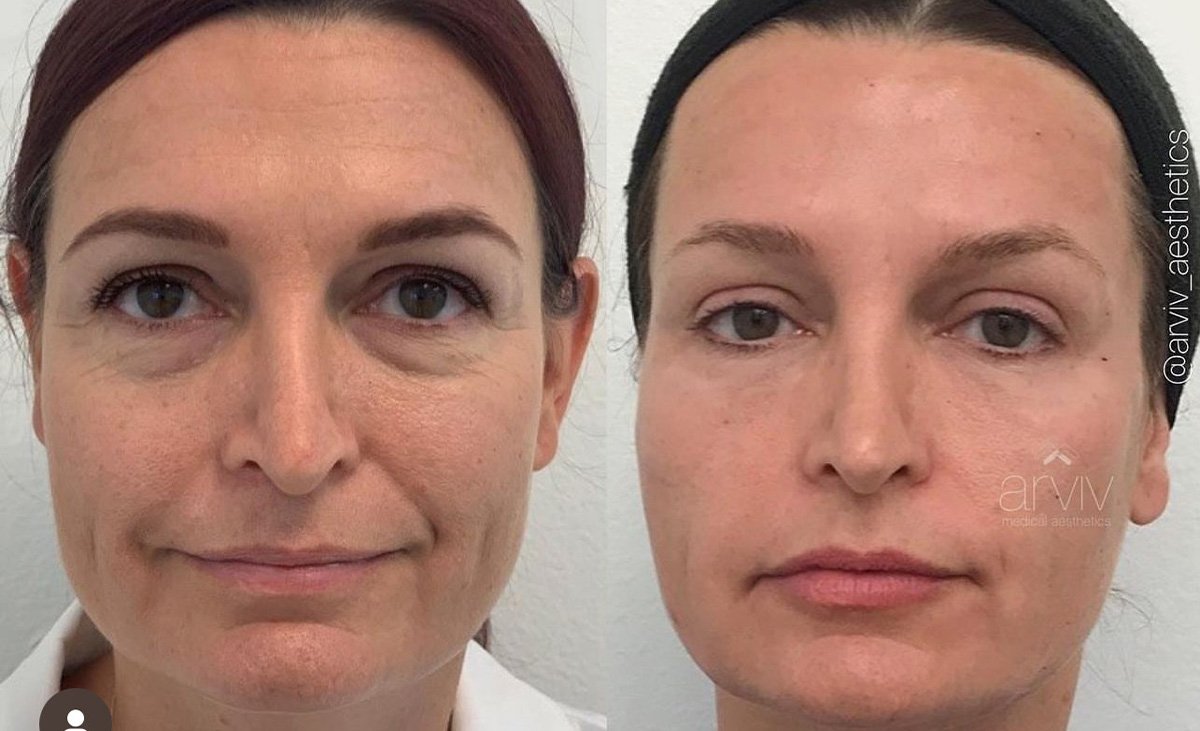 Liquid Facelift before and after