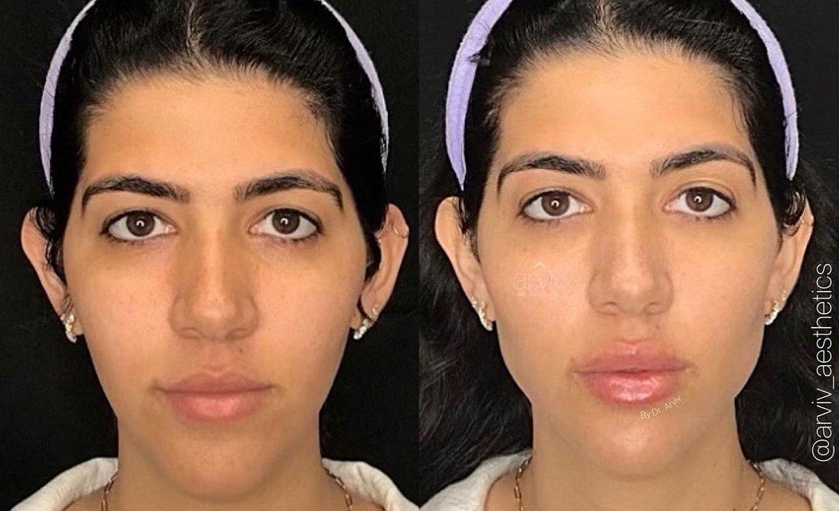 Liquid Facelift before and after