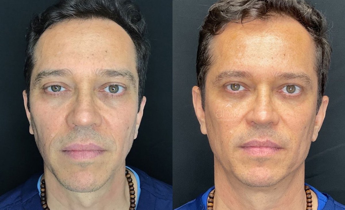 Liquid Facelift Before and After