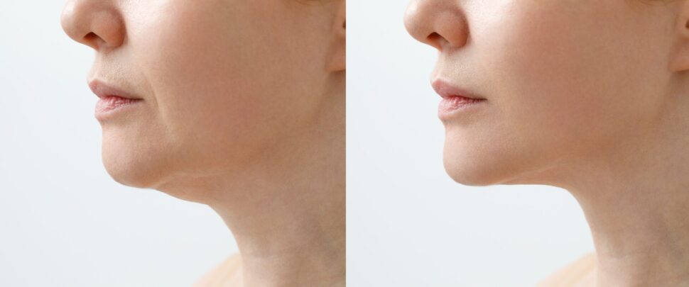 A before and after picture of a womans jaw.
