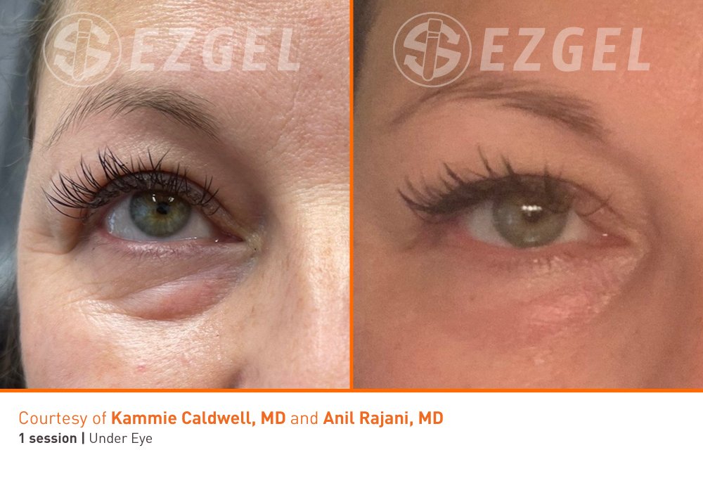 ezgel 10