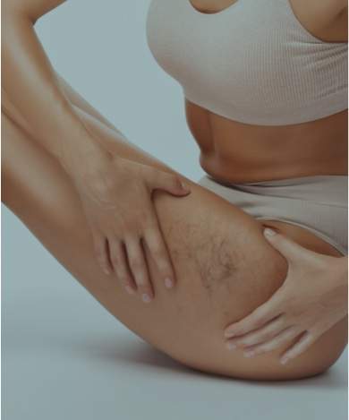 Eliminación de venas varicosas con láser