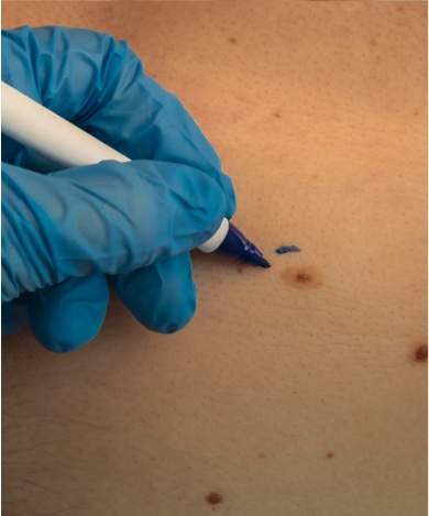 Eliminación de lunares, verrugas y acrocordones
